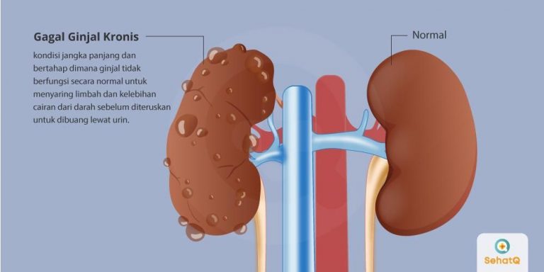 Periksakan Ginjal Setahun Sekali untuk Deteksi Penyakit Gagal Ginjal Periksakan Ginjal Setahun Sekali untuk Deteksi Penyakit Gagal Ginjal
